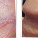 Pearly Penile Papules before and after treatment picture