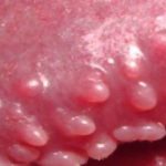 Pearly Penile Papules on Head Image