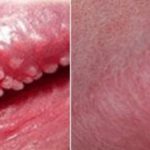 Pearly Penile Papules removal, treatment or cure