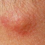 Red Bump formed underneath the Breast Skin – Picture