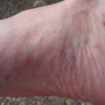 Red Small Bumps on Sole of Foot caused by Lichen Planus