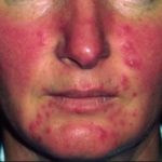 Redness around Nose, Mouth and Cheek-Picture