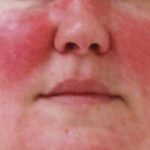 Redness around Nose and Mouth Image- Females