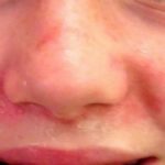 Redness around Nose and Mouth in Child caused by Perioral Dermatitis