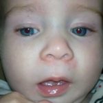 Redness around Nose of a Child Picture