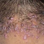 Small Bumps on Scalp and Neck