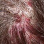 Small Red Painful Ingrown Hair on Scalp