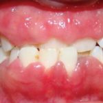 Swollen Gums Picture