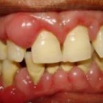 Swollen Gums causes