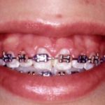 Swollen Gums with Braces