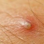 Symptoms of an Infected Ingrown Hair