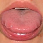 A Scalloped Tongue