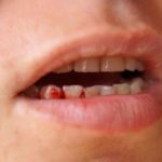 Bleeding Gums in Pregnancy