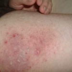 Bumps on Inner Thigh