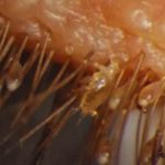 Eyelash Mites Pictures