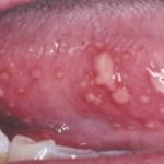 Inflamed Taste Buds under Tongue