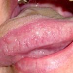 Inflamed Taste buds on Sides of Tongue