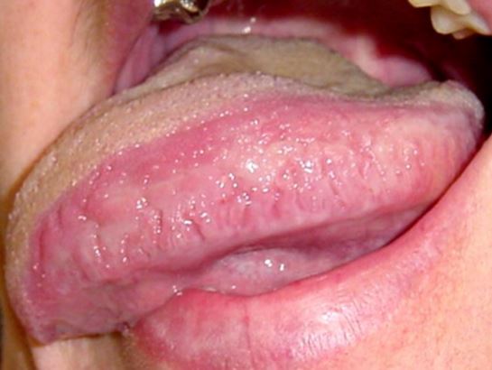 Swollen Taste Buds Inflamed Causes On Si