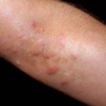 Itchy Bumps on Elbows Image