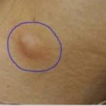 Lump In Armpit Female Picture