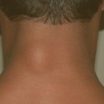 Lump on Back of Neck