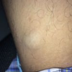 Lump on Inner Thigh under Skin