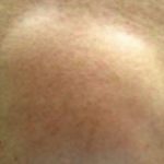 Lump under Armpit Image