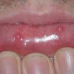 Mucocele on Lips