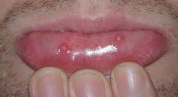 how-to-get-rid-of-mucous-cyst-on-lip-roof-of-mouth-retention-cyst