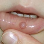 Mucous Cyst on Baby’s Lip Picture