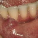 Mucous on Lip Picture