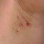 Painful Lumps in Armpit