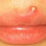 Pimple on Lip