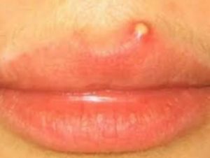 Pimple on Lip