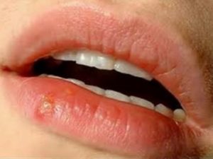 Pimple on Lip Line