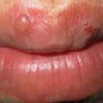 Pimple on Lip or Cold Sore.