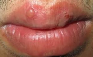 Pimple on Lip or Cold Sore.