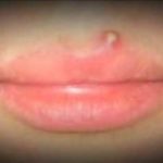 Pimple on Upper Lip Picture