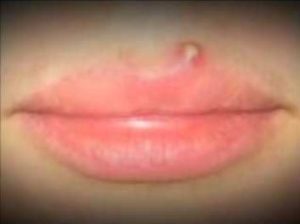 Pimple on Upper Lip Picture