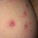 Red Bumps on Buttocks Pictures