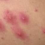 Red Bumps on Buttocks that Hurts or Painful