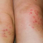 Red Bumps on Knees Pictures