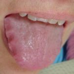 Scalloped Tongue Symptoms