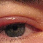 Staphylococcal Blepharitis on Eyelid