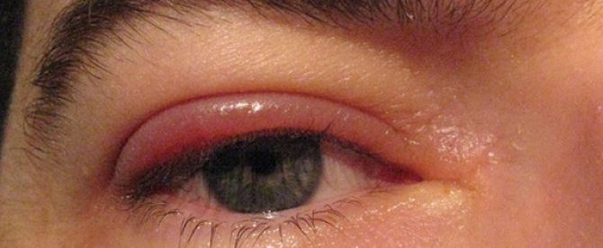 Swollen Eyelid Causes Pictures Allergies Stye Eyelid Gland No