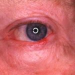 Stye on Lower Eyelid Picture