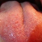 Swollen Taste Buds Image