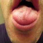 Swollen Taste Buds on Tip of Tongue