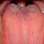 Swollen Taste Buds on back of Tongue