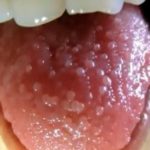 Swollen Taste buds all over Tongue pictures